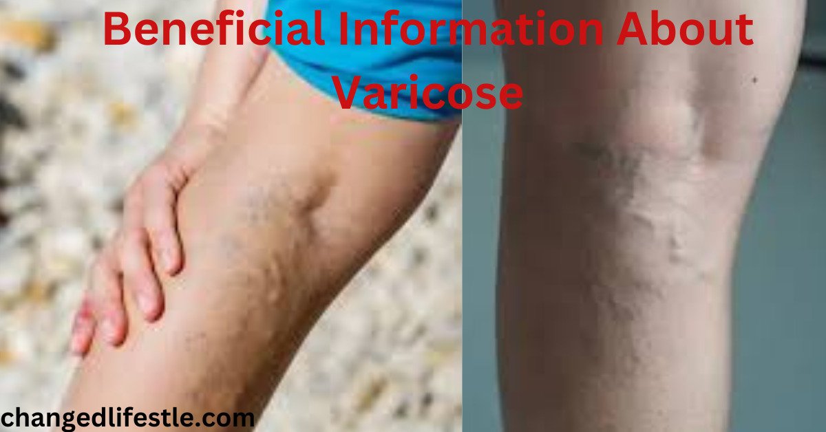 Varicose Information and Home Remedies at the First Stage